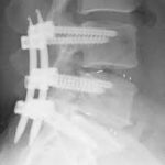 Spinal Fusion, spinal fusion surgery